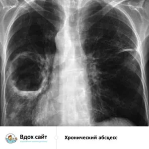 Lung tratament abces, simptome, raze X și semne radiologice, chirurgie operatorie