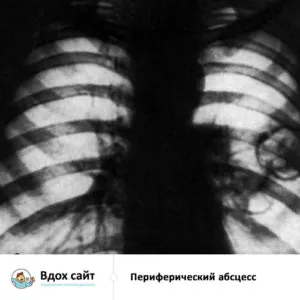 Lung tratament abces, simptome, raze X și semne radiologice, chirurgie operatorie
