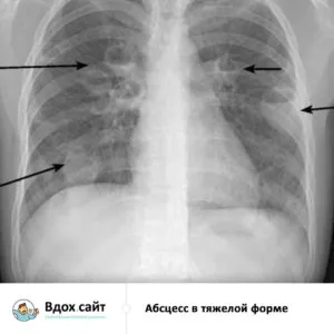 Lung tratament abces, simptome, raze X și semne radiologice, chirurgie operatorie