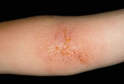 Алергия към бръшлян обрив снимка причинява лечение