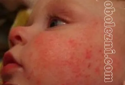 Az atópiás dermatitis gyermekeknél - egy fotót a betegség tüneteit