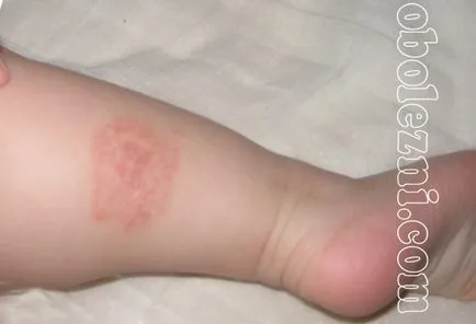 Az atópiás dermatitis gyermekeknél - egy fotót a betegség tüneteit