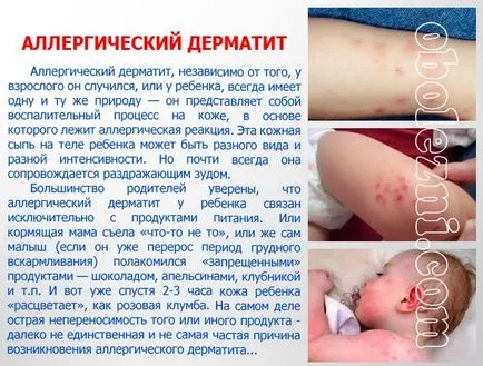 Az atópiás dermatitis gyermekeknél - egy fotót a betegség tüneteit
