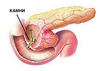 Камъни в панкреаса причини и лечения патология
