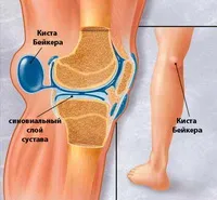 киста на Бейкър