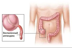 Clasificarea de apendicita