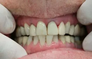 Íny vérzik fogmosás rajta jelzi blog dentaprime klinika
