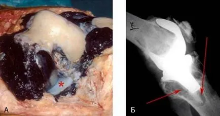 artroplastia de revizie