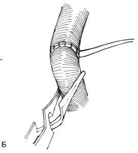 alternativa Aortorenal la chirurgie de by-pass, f Hyman