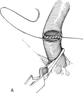 alternativa Aortorenal la chirurgie de by-pass, f Hyman