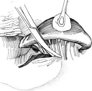 alternativa Aortorenal la chirurgie de by-pass, f Hyman