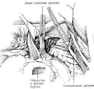 alternativa Aortorenal la chirurgie de by-pass, f Hyman