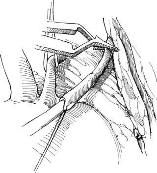 alternativa Aortorenal la chirurgie de by-pass, f Hyman