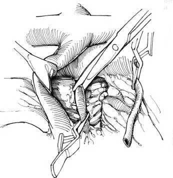 Aortorenal alternatívája bypass műtét, f Hyman