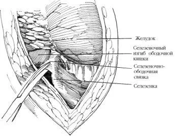 Aortorenal алтернатива на байпас, е Hyman