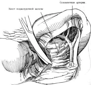 alternativa Aortorenal la chirurgie de by-pass, f Hyman