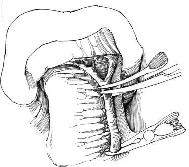 Aortorenal alternatívája bypass műtét, f Hyman