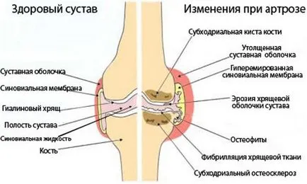 Arthritises ízületek 1, 2, 3 fok okok, tünetek, jelek, a kezelés, megelőzés