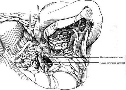 alternativa Aortorenal la chirurgie de by-pass, f Hyman