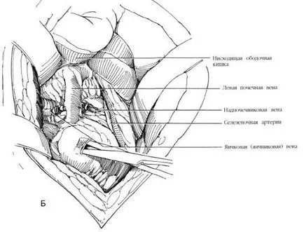 Aortorenal alternatívája bypass műtét, f Hyman