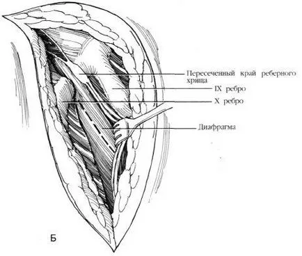 alternativa Aortorenal la chirurgie de by-pass, f Hyman