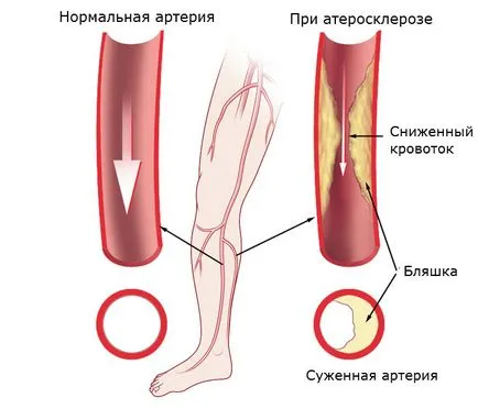 Атеросклерозата на долните крайници