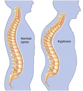 kyphosis kezelés Izrael Árak, visszajelzések, ár