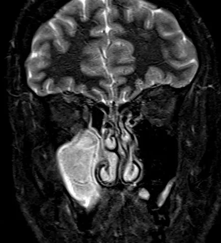 Diagnosticul radiologic al sinuzitei, RMN în St. Petersburg