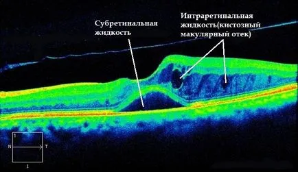 Макулна оток на ретината