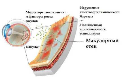 Макулна оток на ретината