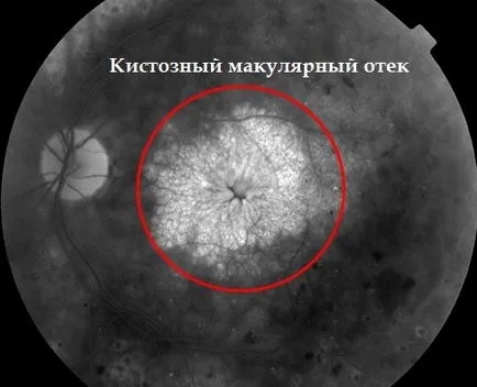 Макулна оток на ретината