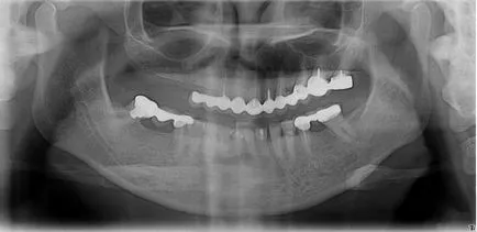 Hátrányai fogászati ​​implantátumok