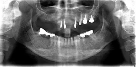 Hátrányai fogászati ​​implantátumok