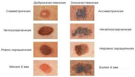 simptome melanom, etape, diagnostic, prognostic