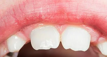 Млечните зъби при децата - колко промени, лечение и отстраняване