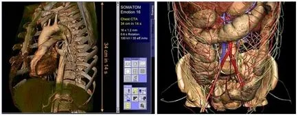 MSCT abdomen cu un contrast