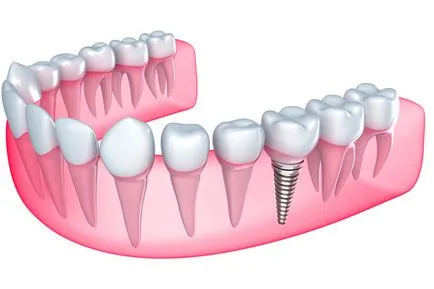 Tehetek fogszabályozó koronák, implantátumok és töltse üregek