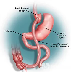 BARIATRIC műtét előnyei és hátrányai