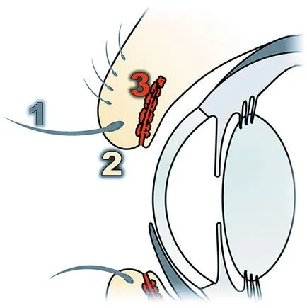 neoplasmele glandelor meibomiane la câini