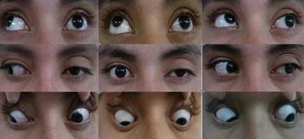Ophthalmoplegia mi ez, internukleáris ophthalmoplegia, külső, teljes, okai és tünetei