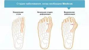 Операция halyus Valgus рехабилитация, последствията и отговори