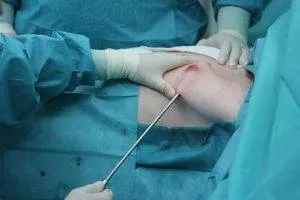 Операцията за отстраняване на гинекомастия при мъжете, лечение преди и след операция от пластични хирурзи