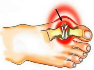 Операция halyus Valgus рехабилитация, последствията и отговори