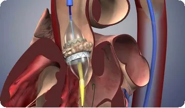 Műtét a mitrális a szív jelzések, szakaszait következmények prognózis