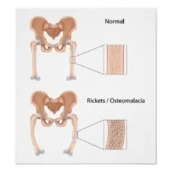 Osteomalacia okok, tünetek és kezelések