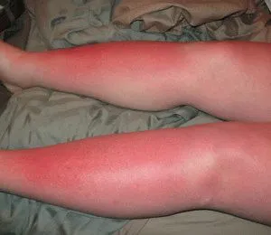 Подуване на краката след слънчево изгаряне причини, последствия, лечение