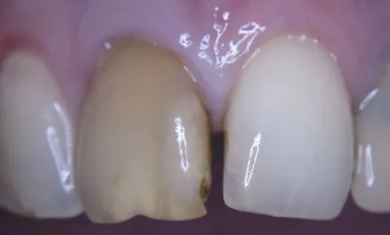 Избелването се промени в цвета на предните зъби и роман