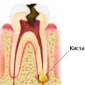 Parestezia (amorțeli) după extracție înțelepciune dinte, dentare