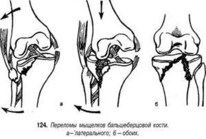 Condylusok törés a sípcsont A kezelés ideje alatt, a következmények, a rehabilitációs