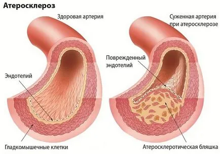 Patogeneza complicatiilor ateroscleroză, prevenirea și tratamentul